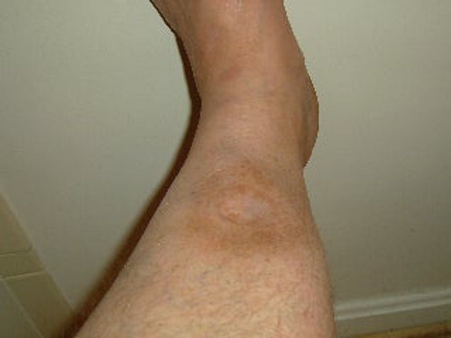 How A Softball Almost Killed This Man's Foot